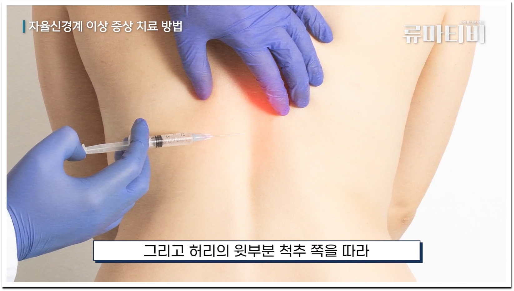 스네피 주사 위치