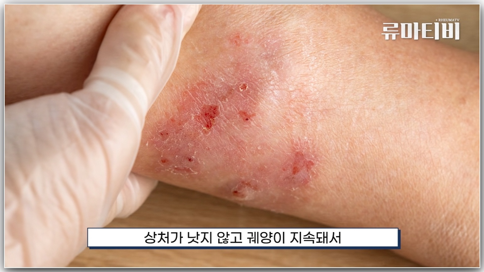 피부 궤양 증상