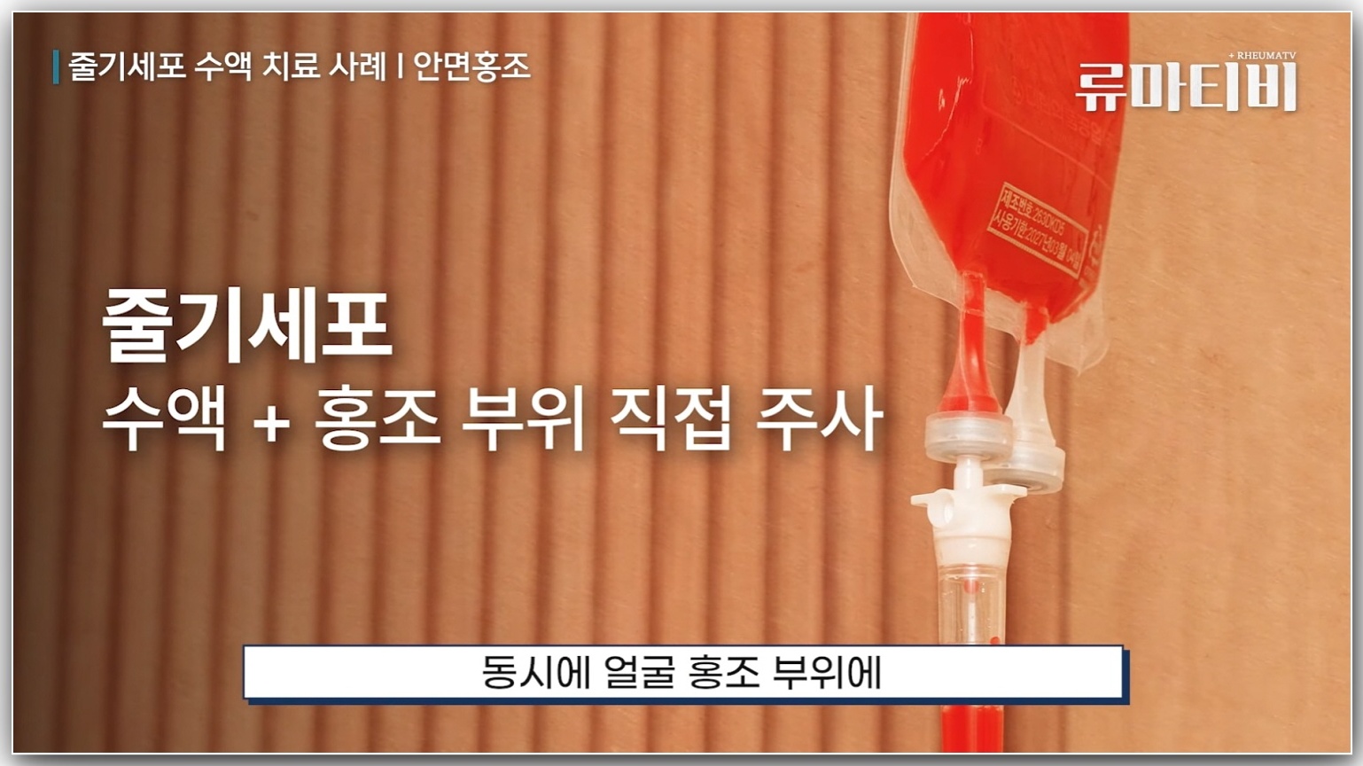 줄기세포 수액과 피부 홍조 부위 주사치료