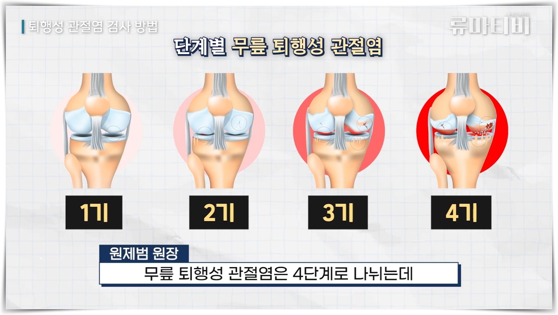 켈그렌 로렌스 분류법에 따른 무릎 퇴행성 관절염 진행 4단계