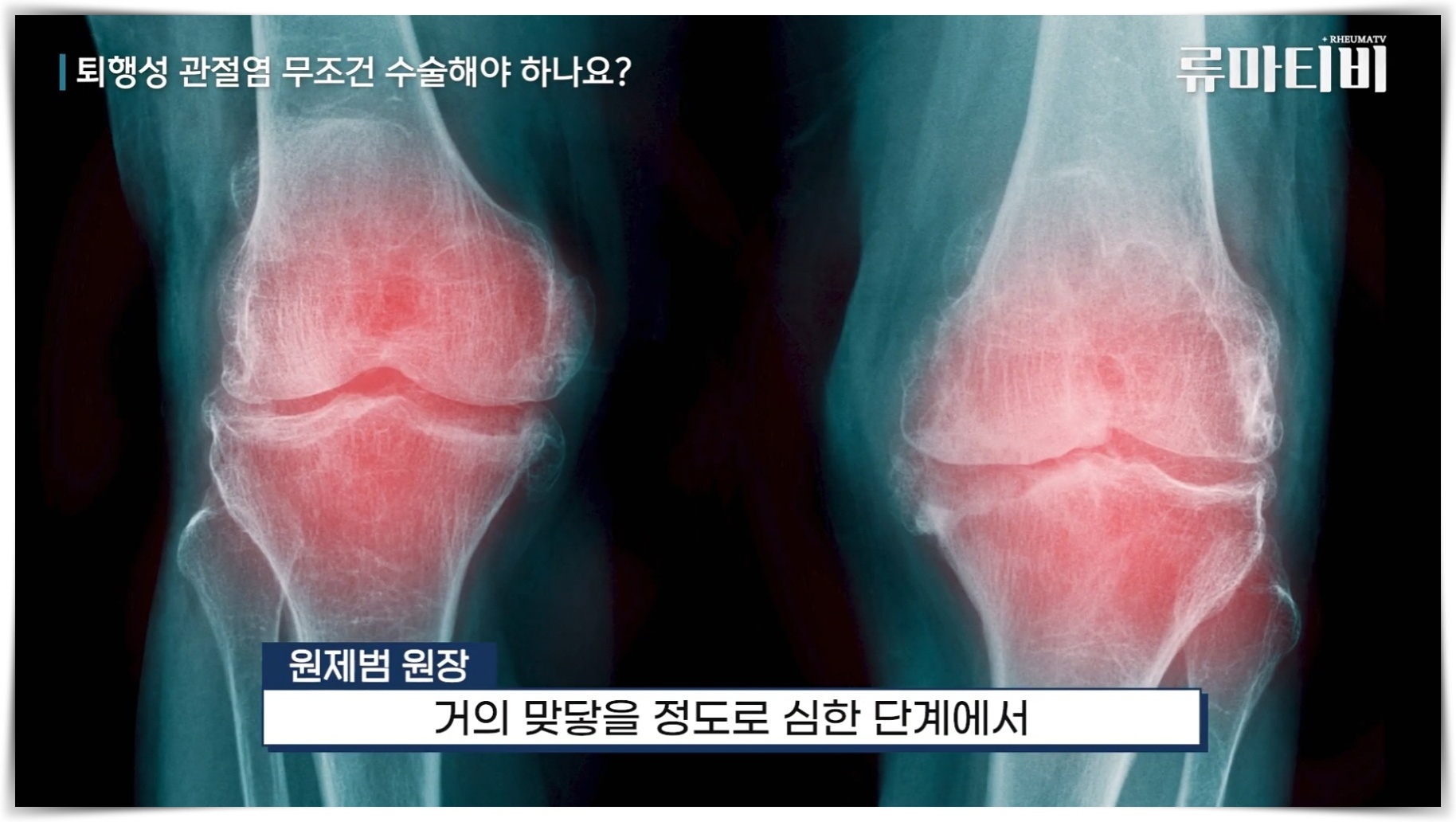 수술은 4단계에서 관절 간격이 매우 협소할 때 진행합니다.