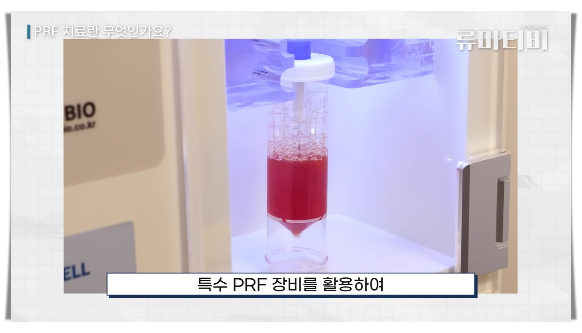 대상포진 후유증 신경통 치료 중 하나인 PRF의 제작 과정