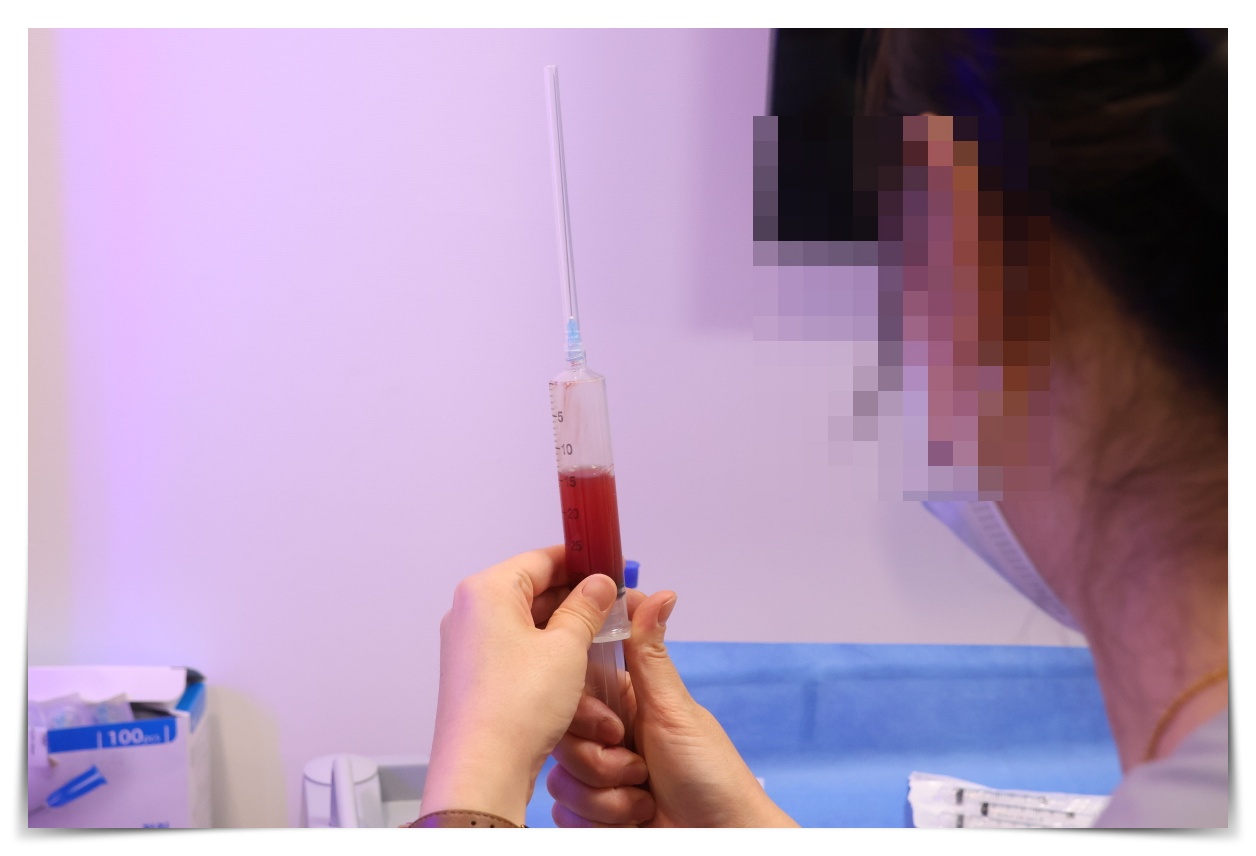 피로감이 너무 심해요, 만성피로증후군 증상
