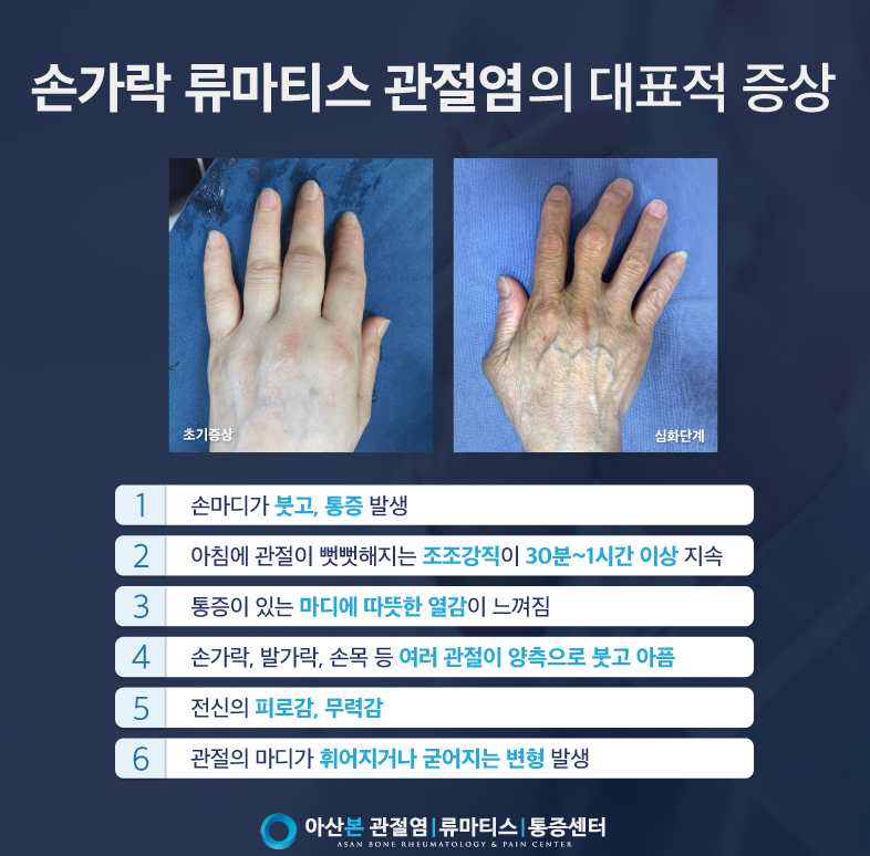 손가락 관절염 초기 증상 설명